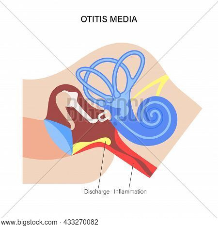 Otitis Media, Ear Disease Concept. Pain And Inflammation, Earache In The Human Head. Medical Checkup