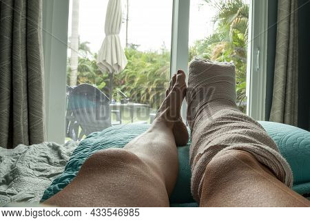 Foot In A Cast After The First Week Of Bunion Foot Surgery