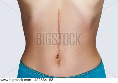 Closeup Of Young Woman With Large Scar After Surgery On Abdomen. Medical Treatment And Scars Removal