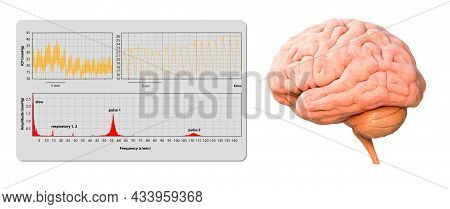 Intracranial Pressure Monitoring Icp Waveform, 3d Render, 2d Graphic, Illustration