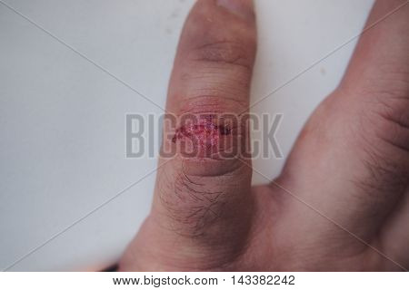 Trauma thumb. The fresh wound on his little finger.