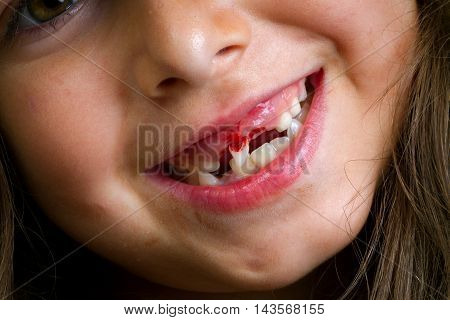 A little girl grins after loosing one front tooth. The second front tooth is loose enough that she is turning it sideways for the camera. The view is mostly mouth with a hint of her smiling eye.