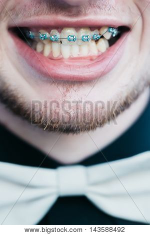 Smiling mouth with metal medical dental brace on upper jaw of crooked teeth with unshaven male face and dressed in black shirt and white bow tie background closeup