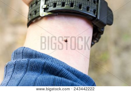 The Tick Bites His Hand. Mite Under The Skin. The Hand Of Man. Tick In The Forest.