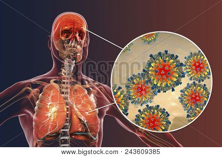 Measles Induced Complications, Conceptual Image. 3d Illustration Showing Pneumonia And Encephalitis 