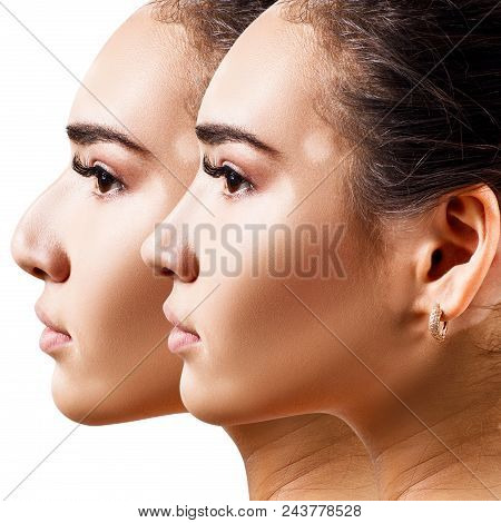 Female Nose Before And After Cosmetic Surgery. Woman With Vitiligo.