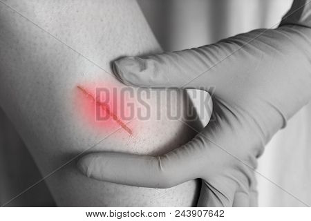 Child Injured. Close Up Wound On Child Leg.