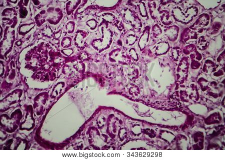 Histopathology Of Diffuse Sclerosing Glomerulonephritis, Light Micrograph, Photo Under Microscope