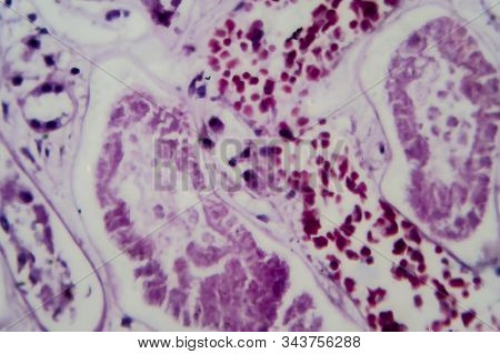 Acute Glomerulonephritis, Light Micrograph, Photo Under Microscope. High Magnification