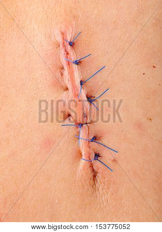 Non Absorbable Sutures