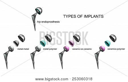 Vector Illustration Of Types Of Implants By Type Of Material