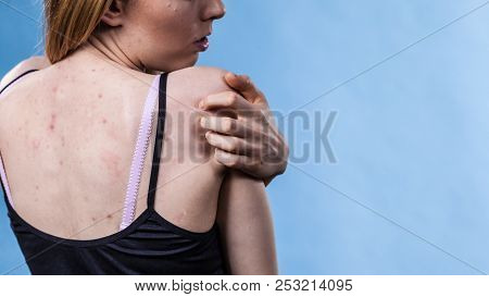 Health Problem, Skin Diseases. Young Woman Showing Her Back With Acne, Red Spots. Teen Girl Scratchi