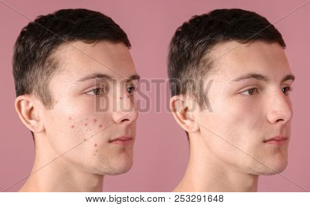 Young Man With Acne Problem On Color Background