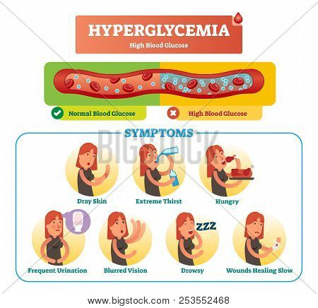 Hyperglycemia Vector Illustration Collection Set. Isolated And Labeled Symptom, Diagnosis And Signs 