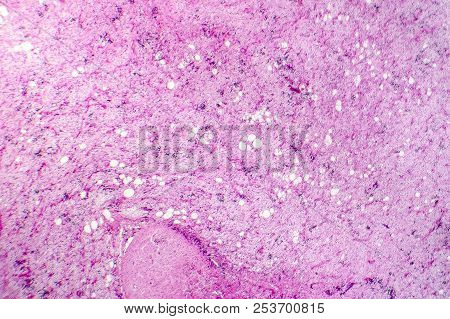 Liposarcoma, Soft Tissue Sarcoma, Light Micrograph, Photo Under Microscope