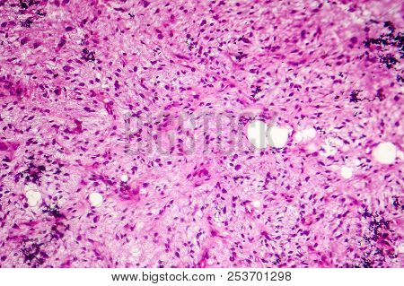 Liposarcoma, Soft Tissue Sarcoma, Light Micrograph, Photo Under Microscope