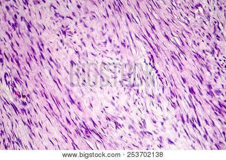 Fibroma, A Benign Tumour Of Fibrous Tissue, Light Micrograph, Photo Under Microscope