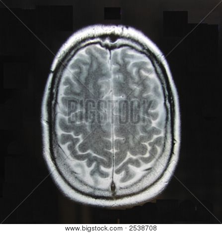 Mri_Of_Brain_Alone
