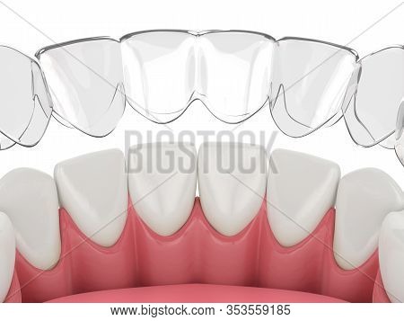 3d Render Of Invisalign Removable And Invisible Retainer With Lower Jaw Over White Background