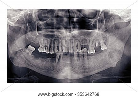 Panoramic Dental X-ray Of An Elderly Person. Bad Teeth Fell Out. Snapshot Of The Pensioners Jaw. Ort