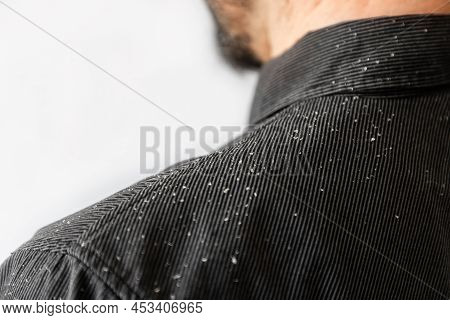 A Bearded Man In A Black Shirt, A Close Up View Of The Shoulder Covered With Dandruff. Copy Space. T