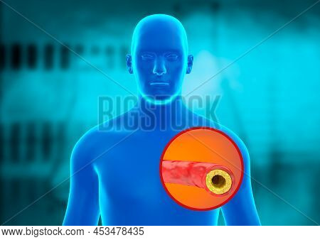 Human Body Blue Hologram. Atherosclerosis Is The Buildup Of Cholesterol Plaques On The Walls Of The 