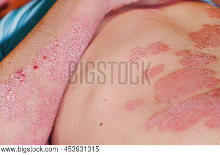 Acute Psoriasis In A Man, Severe Redness On The Skin, An Autoimmune Incurable Dermatological Skin Di