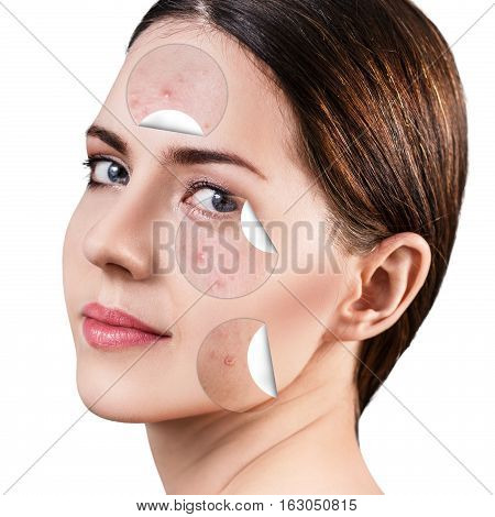 Circles layers of skin with acne unstick from good healthy skin of young woman.