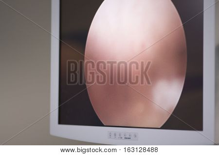 Arthroscopy Surgery Screen