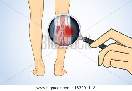 Zoom in Calf Muscle of human with magnifier for check Muscular System. Have a red sign on muscles. Illustration about medical and health care.