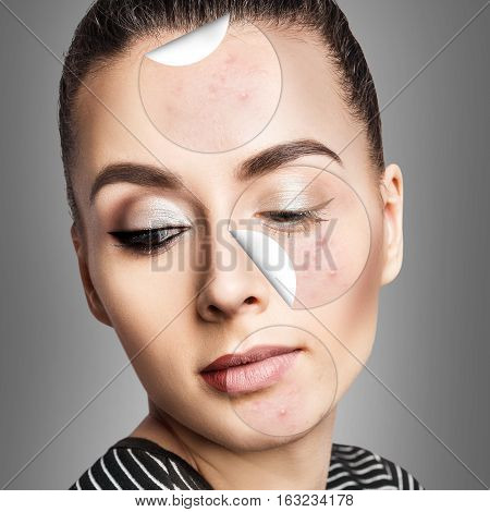 Circles layers of skin with acne unstick from good healthy skin of young woman.