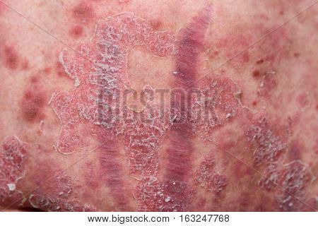 Psoriasis is an autoimmune disease that affects the skin cause skin inflammation red and scaly.