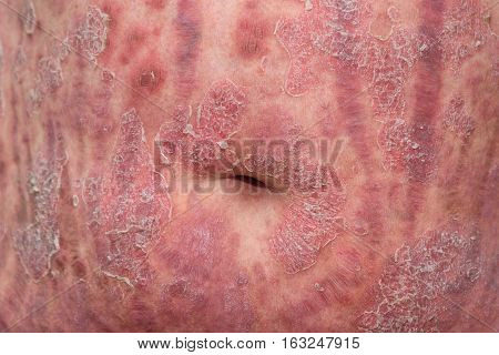 Psoriasis is an autoimmune disease that affects the skin cause skin inflammation red and scaly.