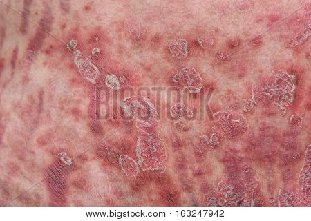 Psoriasis is an autoimmune disease that affects the skin cause skin inflammation red and scaly.