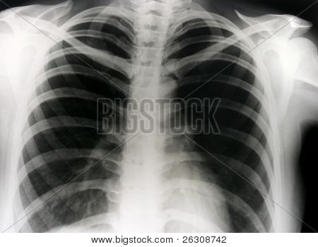Mellkas röntgen