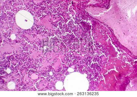 Lobar Pneumonia, Hemorrhagic Edema Period, Light Micrograph, Photo Under Microscope