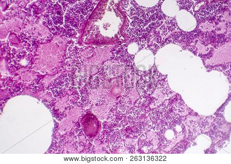 Lobar Pneumonia, Hemorrhagic Edema Period, Light Micrograph, Photo Under Microscope
