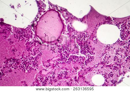 Lobar Pneumonia, Hemorrhagic Edema Period, Light Micrograph, Photo Under Microscope
