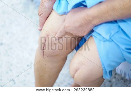 Asian Senior Or Elderly Old Lady Woman Patient Show Her Scars Surgical Total Knee Joint Replacement 