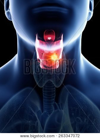 3d rendered medically accurate illustration of a mans larynx cancer