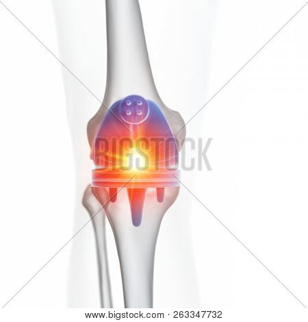 3d rendered medically accurate illustration of a knee replacement