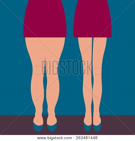 Female Thick And Slender Legs Before And After Weight Loss, Beautiful Body, Liposuction Legs, Legs M