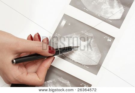 여자 의사는 난소의 초음파 분석에서 가리키는
