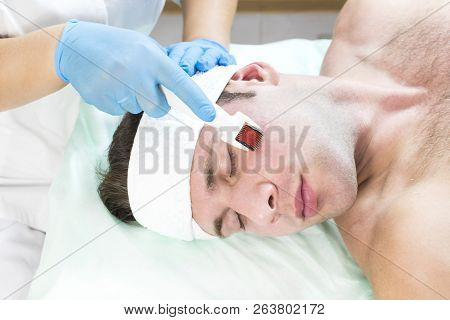 The Man Undergoes The Procedure Of Medical Micro Needle Therapy With A Modern Medical Instrument Der
