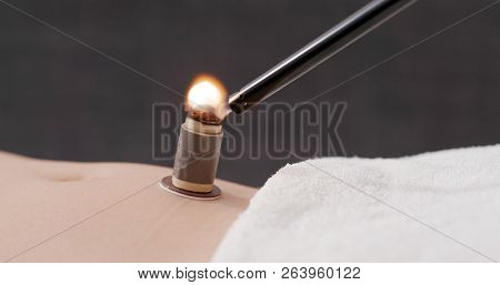 Chinese traditional medicine moxibustion therapy 