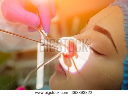 Endoscopic Sinus Surgery. Laser Vaporization Of Nasal Concha