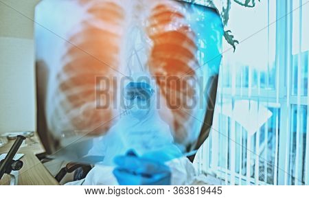 COVID-19 or 2019-nCoV. Portrait of a doctor pneumologist examines an x-ray picture of the lungs of a patient with coronavirus pneumonia. Hospital. 