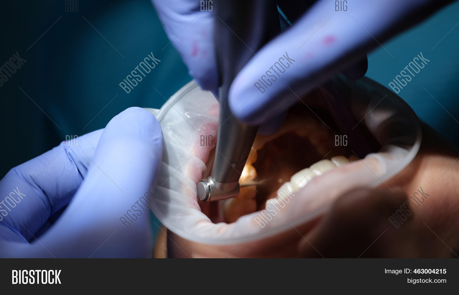 Dentist Drills Tooth Image & Photo (Free Trial) Bigstock