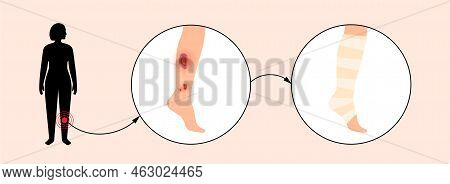 Sore, Cut Or Ulcer On Human Leg. Elastic Bandage, Wrap Medical Gauze Over Foot. Healthcare Concept. 