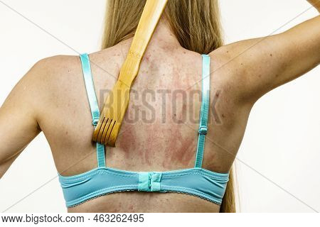 Itchy Skin, Dermatitis, Food Allergies. Woman Using Scratching Wood Stick To Scratch Her Back Side. 